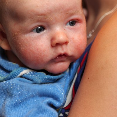Infant with eczema on face