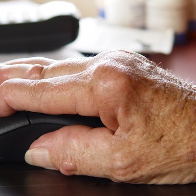 Arthritic hand using a computer mouse.