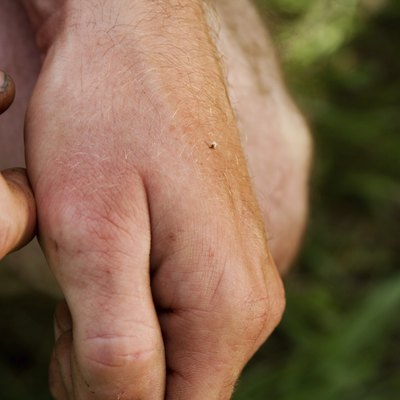 Bee sting on hand