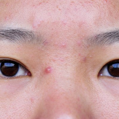 acne on face