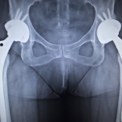 X-ray scan image of hip joint replacement orthopedic implant