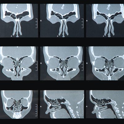 Sinus MRI
