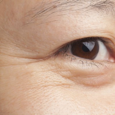 Eye wrinkles