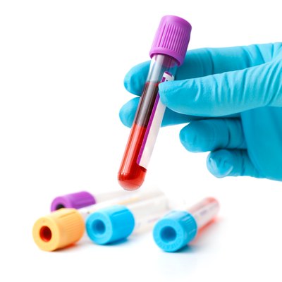 low mpv blood test mayo clinic low mpv blood test mayo clinic