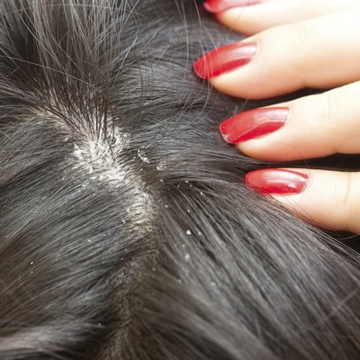Dandruff problem