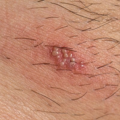 Herpes on the human body