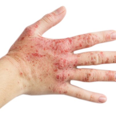 Eczema on a female hand
