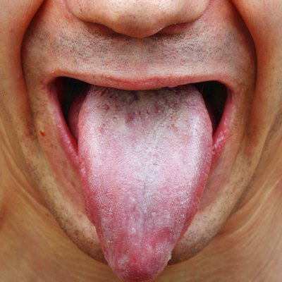 Infection tongue