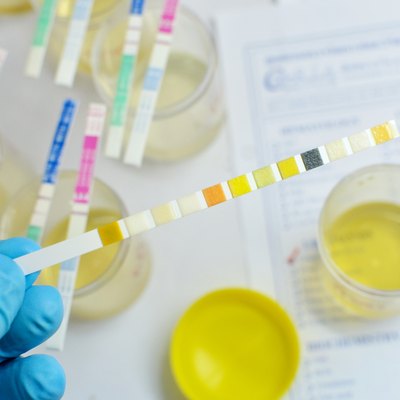 Urine analysis