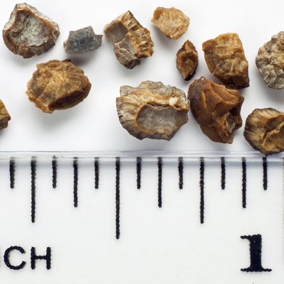 Kidney stones