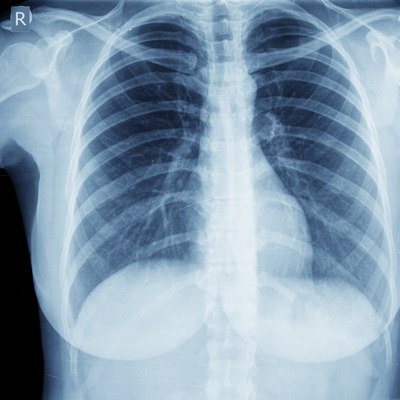 Chest X-Ray
