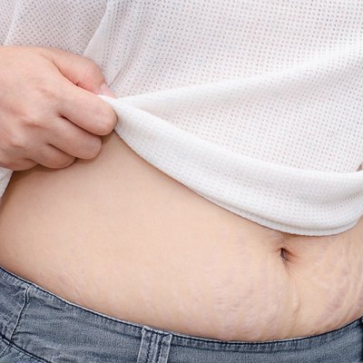 woman showing her stretch marks