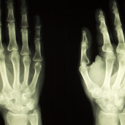 Hand finger thumb hospital xray scan