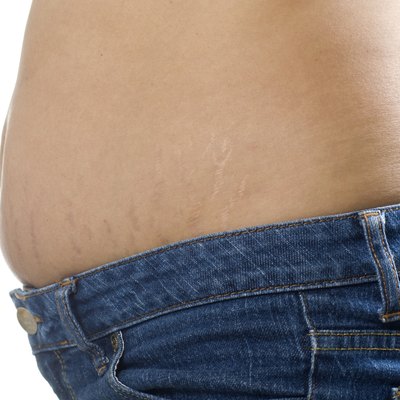 Stretch Mark