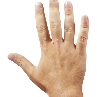 Hand with warts on white background