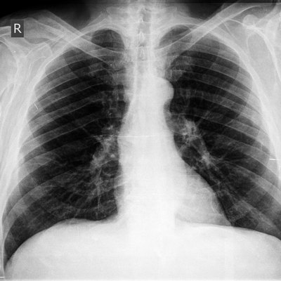 Chest X-ray image