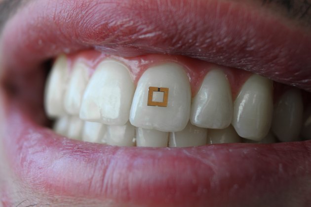 closeup of mouth and teeth with tooth fitbit