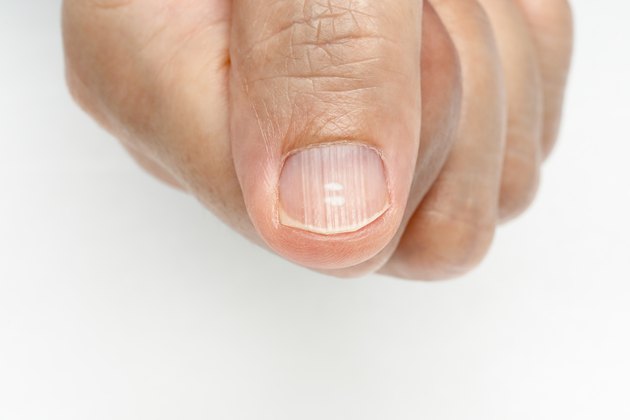 White spots and Vertical ridges on the fingernails symptoms