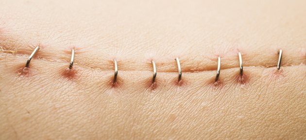 how-long-do-surgical-staples-stay-in-livestrong