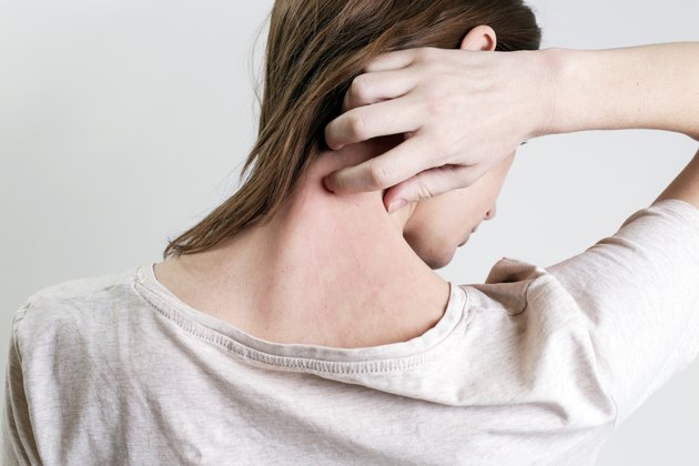 Close up view of woman scratching her neck due to allergies