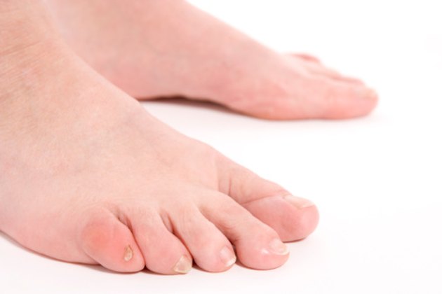 toenail-falling-off-symptoms-causes-and-treatment