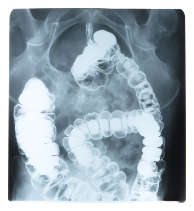 Types Of Sigmoid Colon Polyps