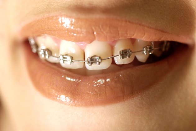 Bad Effects Of Braces | Livestrong.com