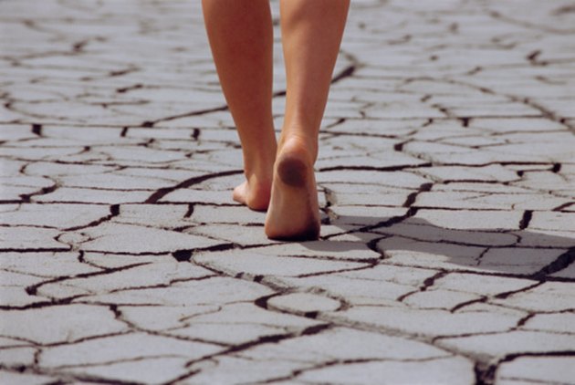 What Are the Causes of Sudden Dry Feet? | Livestrong.com