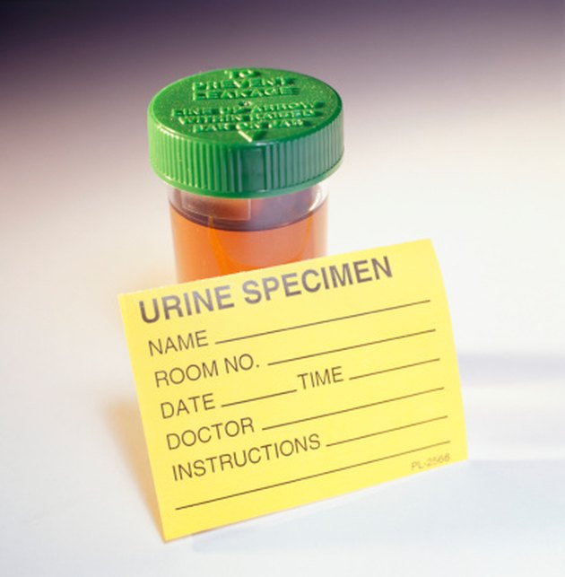 How to Reduce Acid in Urine