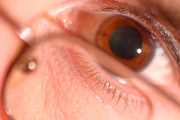 side-effects-of-dilating-eyes-livestrong