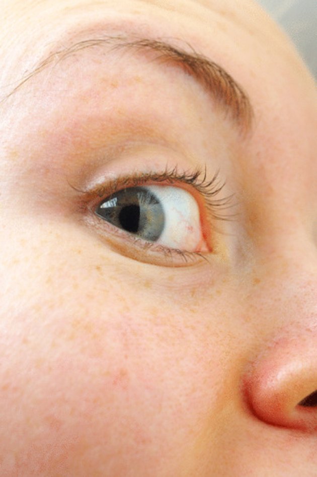 white-bump-on-the-inside-of-the-eye-livestrong