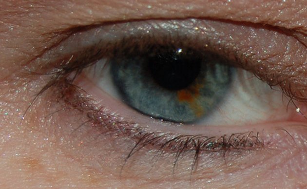 Dark Spots on the White of the Eye | Livestrong.com