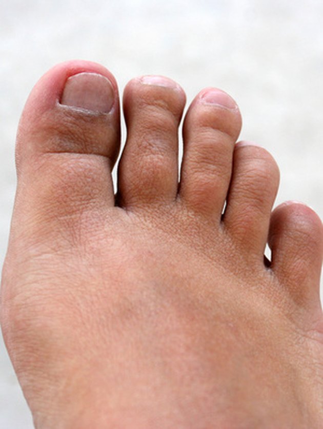 Do Toe Infections Need Antibiotics