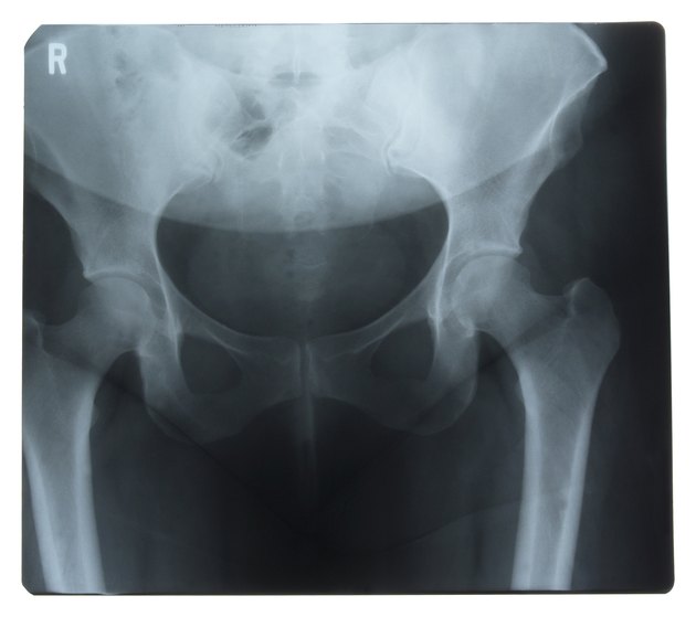 hip joint xray normal