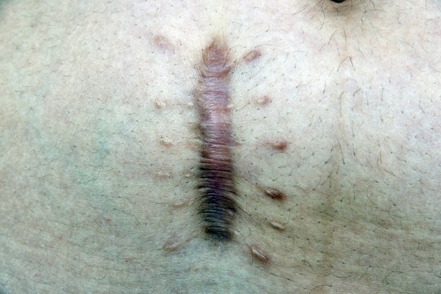 skin scar