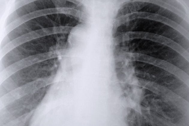 A wheezing cough, phlegm, a respiratory infection