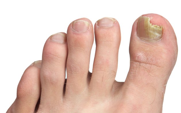 Toenail Fngus at Peak Infection
