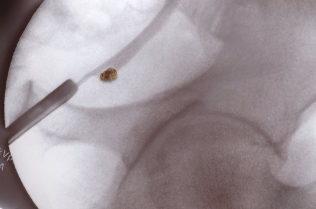 Kidney Stone Positioned on X-ray