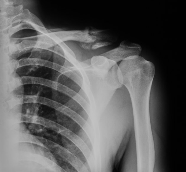 X-ray image of broken clavicle, AP view.