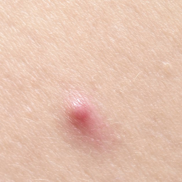 pimple