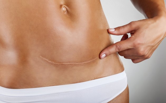 Scar of caesarean section