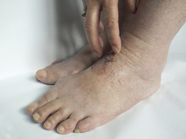 itchy eczema