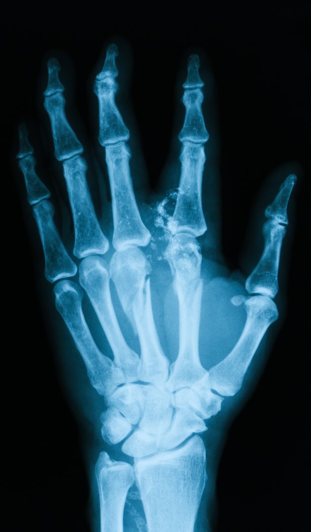 X-ray image of broken hand, PA view.