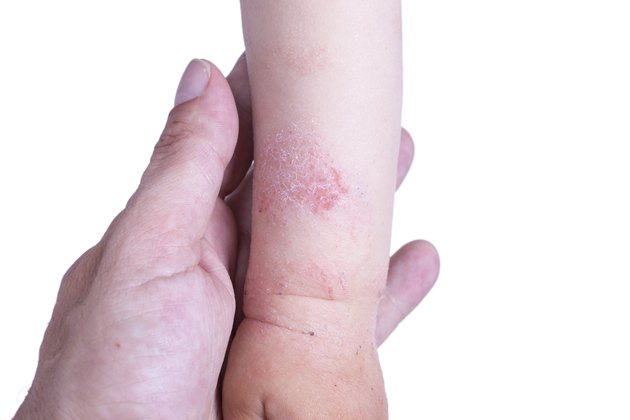 what-causes-itchy-skin-in-children-livestrong