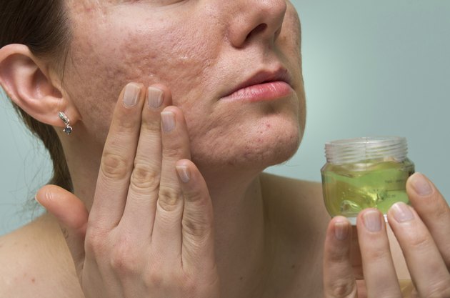 Acne therapy