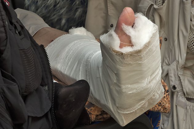 Broken Foot