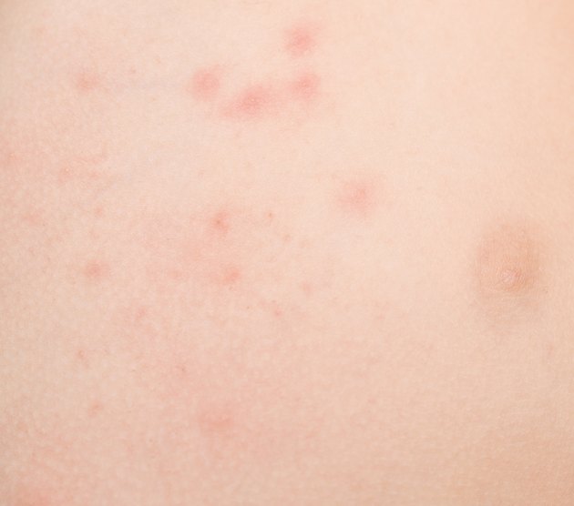 rash