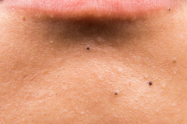 Closeup on pimples, acne, zit, blackheads below lips of teenager