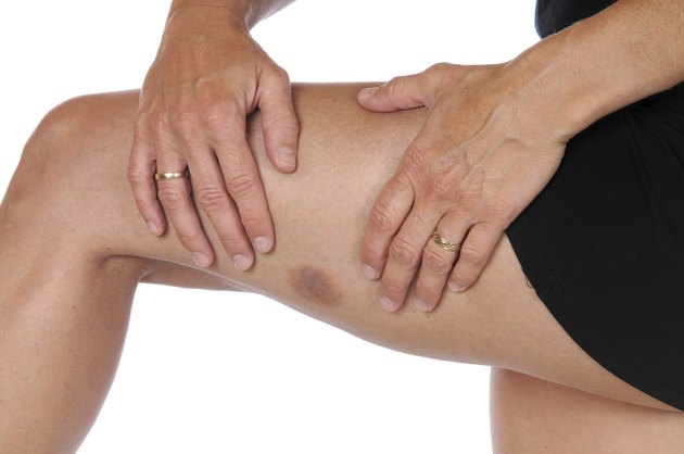 Hematoma