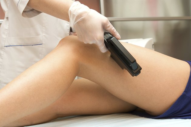 Laser epilation